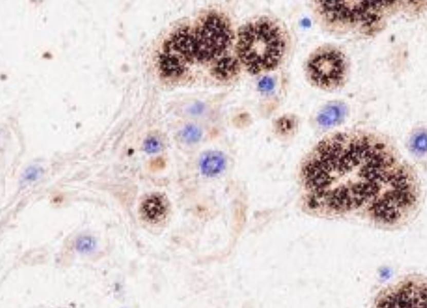 Does Alzheimer's Disease Accelerate Brain Aging by More Than a Decade?